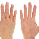 Eczema Dermatitis On Front And Back Of Hand