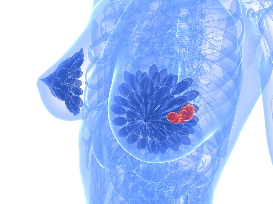 Treating Breast Cancer with Cannabis – Why the Treatment Must Match the Classification!