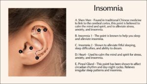 Insomnia Ear Seeds in Ear